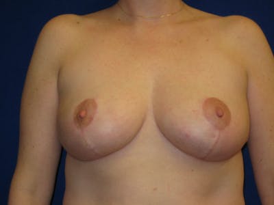 Breast Reduction Before & After Gallery - Patient 87551512 - Image 2