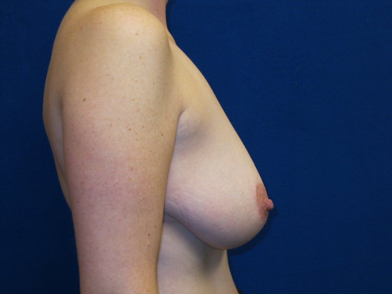 Breast Reduction Before & After Gallery - Patient 87551512 - Image 3
