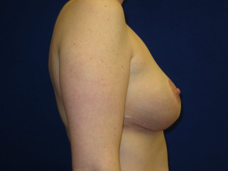 Breast Reduction Before & After Gallery - Patient 87551512 - Image 4