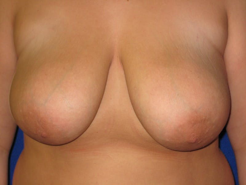 Breast Reduction Before & After Gallery - Patient 87551531 - Image 1