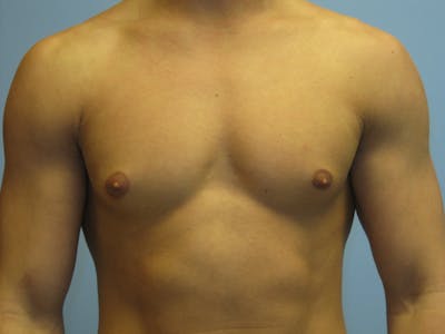 Gynecomastia Before & After Gallery - Patient 87551546 - Image 1