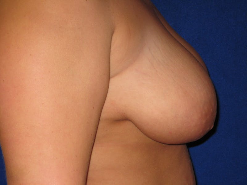 Breast Reduction Before & After Gallery - Patient 87551531 - Image 3