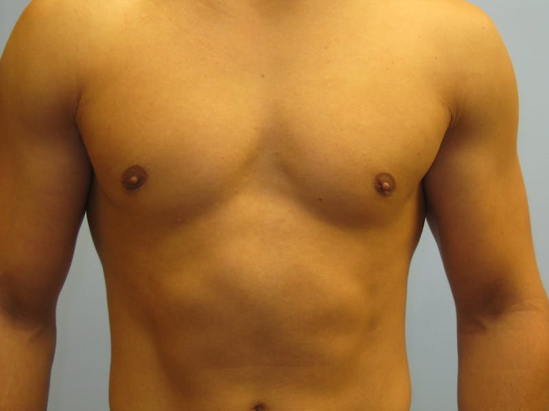 Gynecomastia Before & After Gallery - Patient 87551546 - Image 2