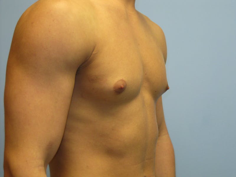 Gynecomastia Before & After Gallery - Patient 87551546 - Image 3
