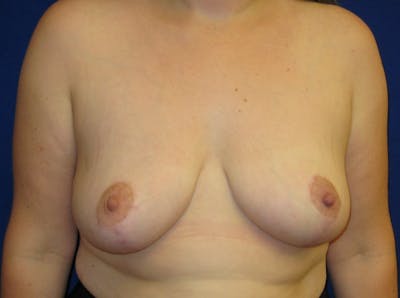 Breast Reduction Before & After Gallery - Patient 87551558 - Image 2