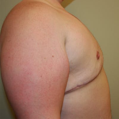 Mastectomy Before & After Gallery - Patient 87551561 - Image 2