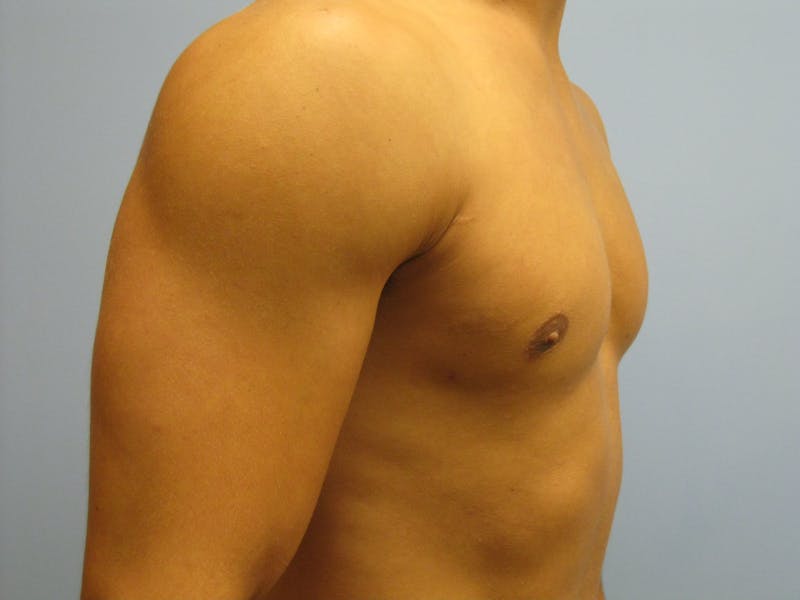 Gynecomastia Before & After Gallery - Patient 87551546 - Image 4