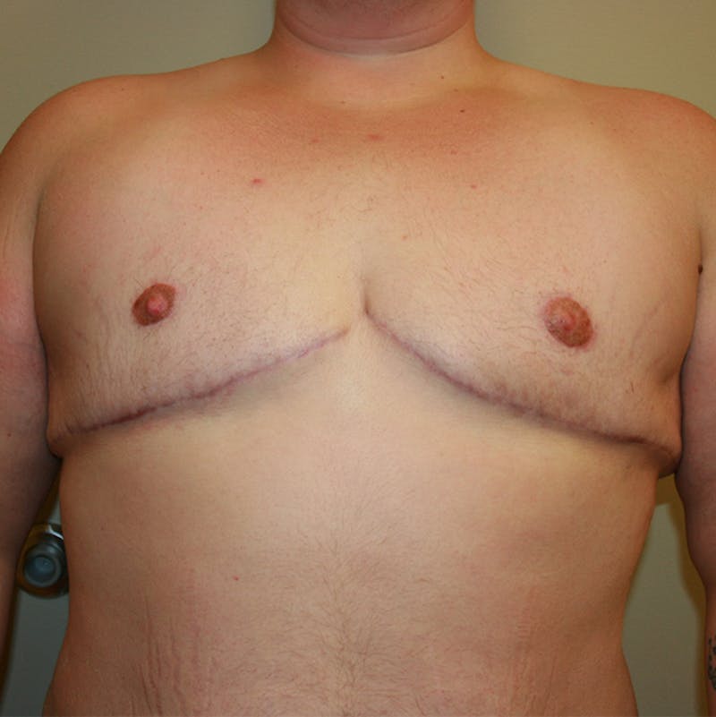 Mastectomy Before & After Gallery - Patient 87551561 - Image 4