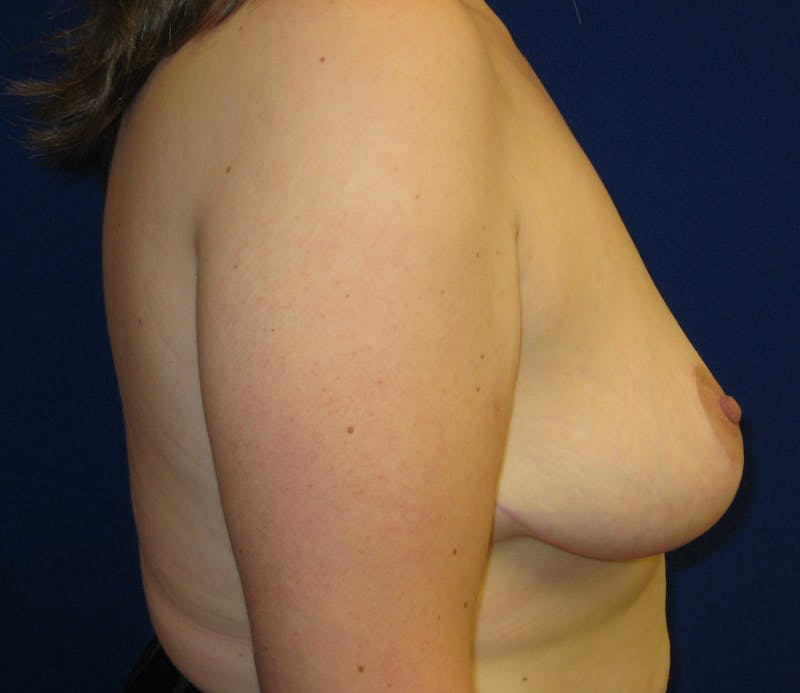 Breast Reduction Before & After Gallery - Patient 87551558 - Image 4