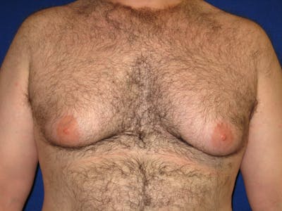 Gynecomastia Before & After Gallery - Patient 87551564 - Image 1