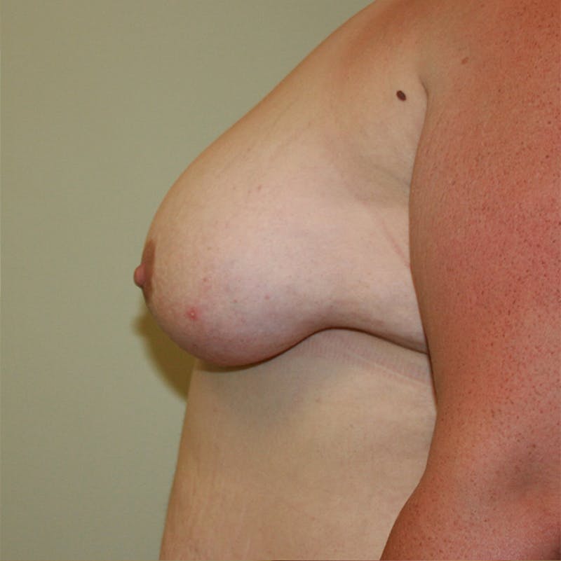 Mastectomy Before & After Gallery - Patient 87551561 - Image 5