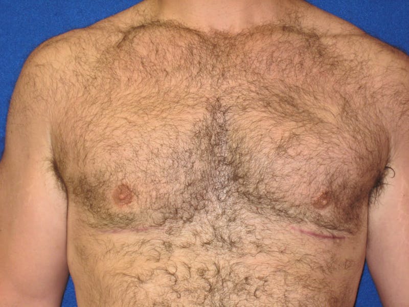 Gynecomastia Before & After Gallery - Patient 87551564 - Image 2