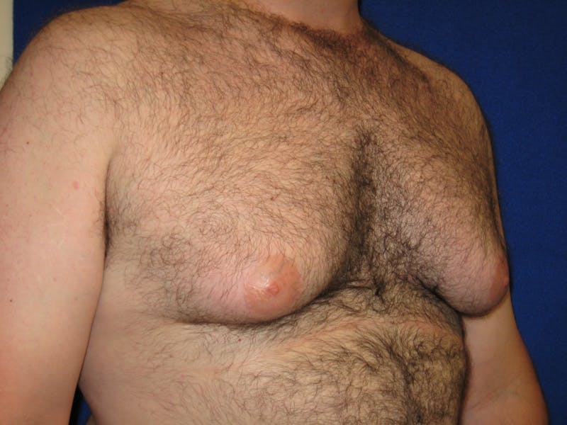 Gynecomastia Before & After Gallery - Patient 87551564 - Image 3
