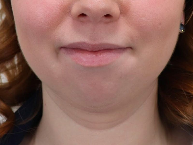 Chin Implants Before & After Gallery - Patient 87551582 - Image 1