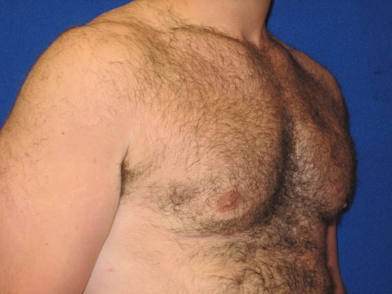 Gynecomastia Before & After Gallery - Patient 87551564 - Image 4