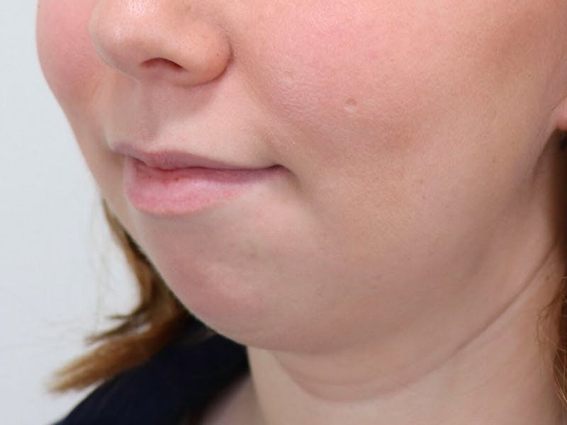 Chin Implants Before & After Gallery - Patient 87551582 - Image 3
