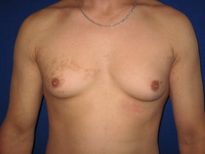 Gynecomastia Before & After Gallery - Patient 87551586 - Image 1