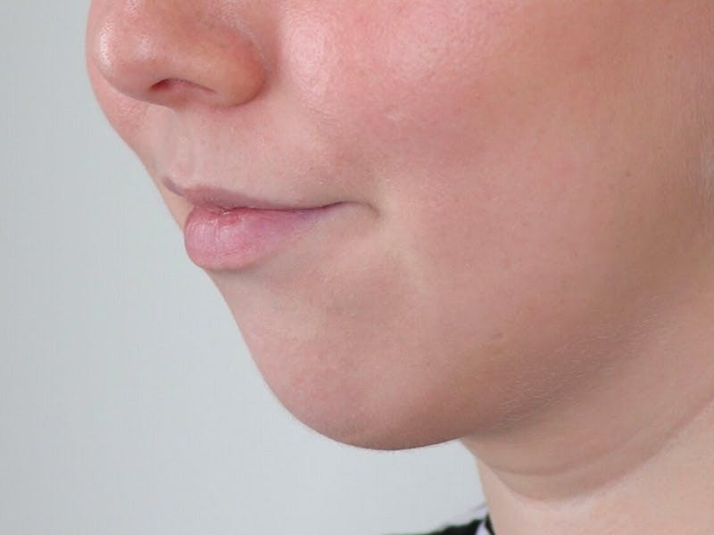 Chin Implants Before & After Gallery - Patient 87551582 - Image 4