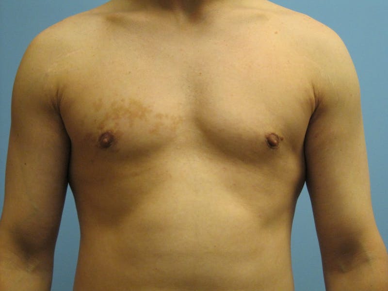Gynecomastia Before & After Gallery - Patient 87551586 - Image 2