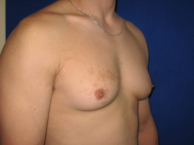 Gynecomastia Before & After Gallery - Patient 87551586 - Image 3