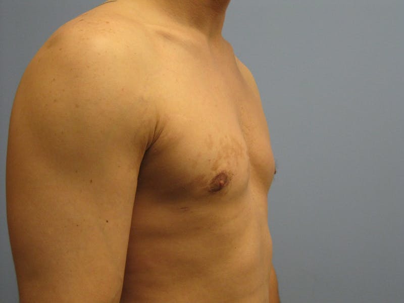 Gynecomastia Before & After Gallery - Patient 87551586 - Image 4