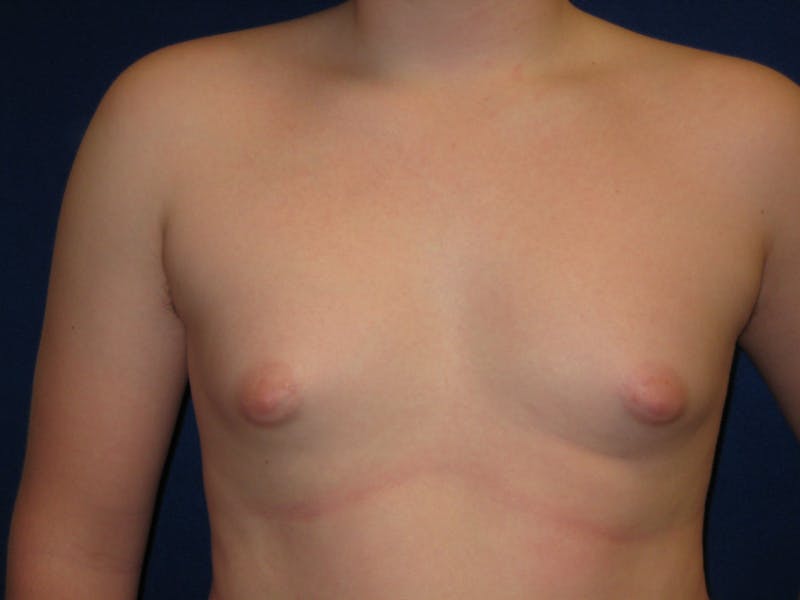Gynecomastia Before & After Gallery - Patient 87551594 - Image 1
