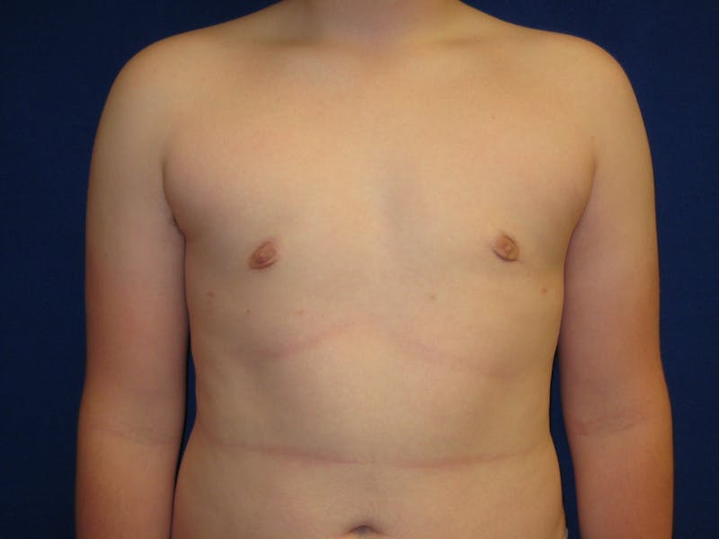 Gynecomastia Before & After Gallery - Patient 87551594 - Image 2