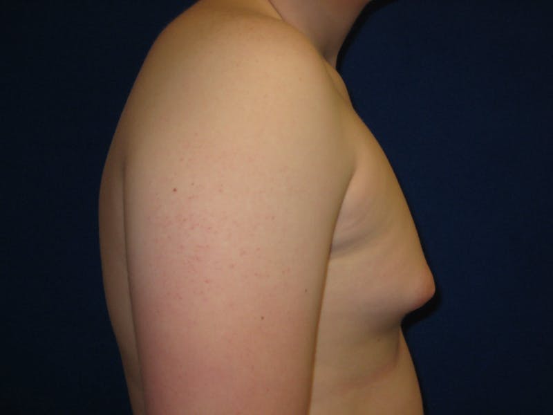 Gynecomastia Before & After Gallery - Patient 87551594 - Image 3
