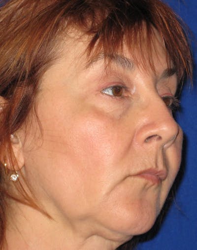 Necklift Before & After Gallery - Patient 87551617 - Image 1