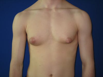 Gynecomastia Before & After Gallery - Patient 87551610 - Image 1