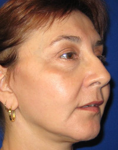 Necklift Before & After Gallery - Patient 87551617 - Image 2