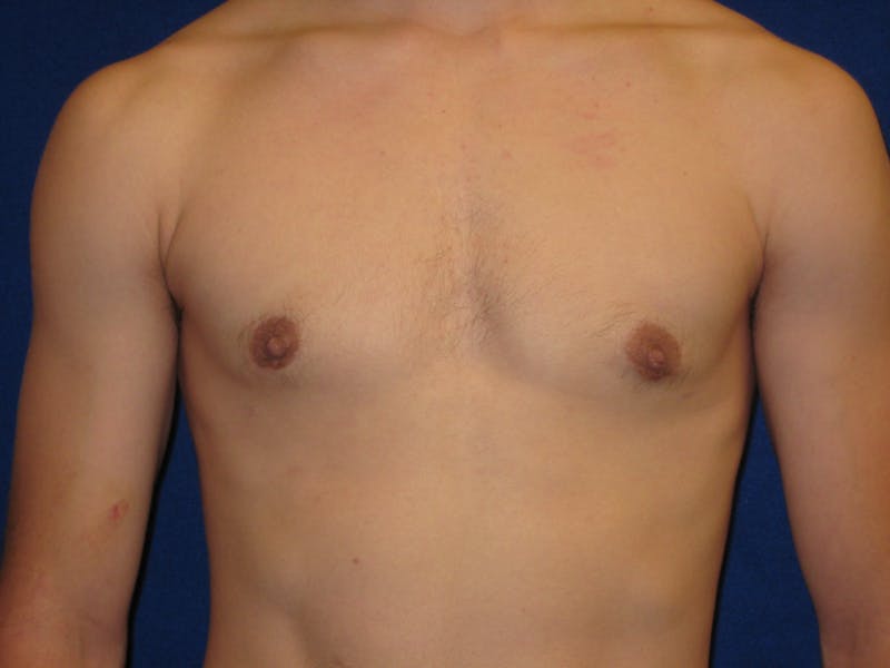 Gynecomastia Before & After Gallery - Patient 87551610 - Image 2