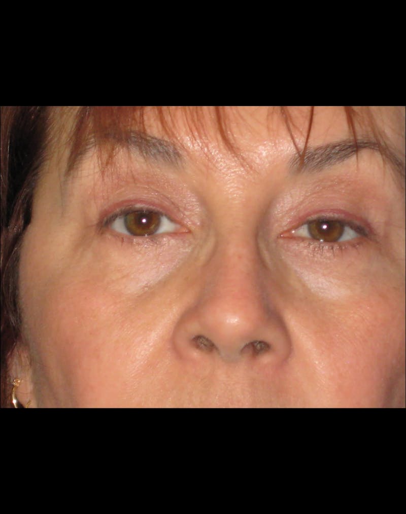 Necklift Before & After Gallery - Patient 87551617 - Image 3