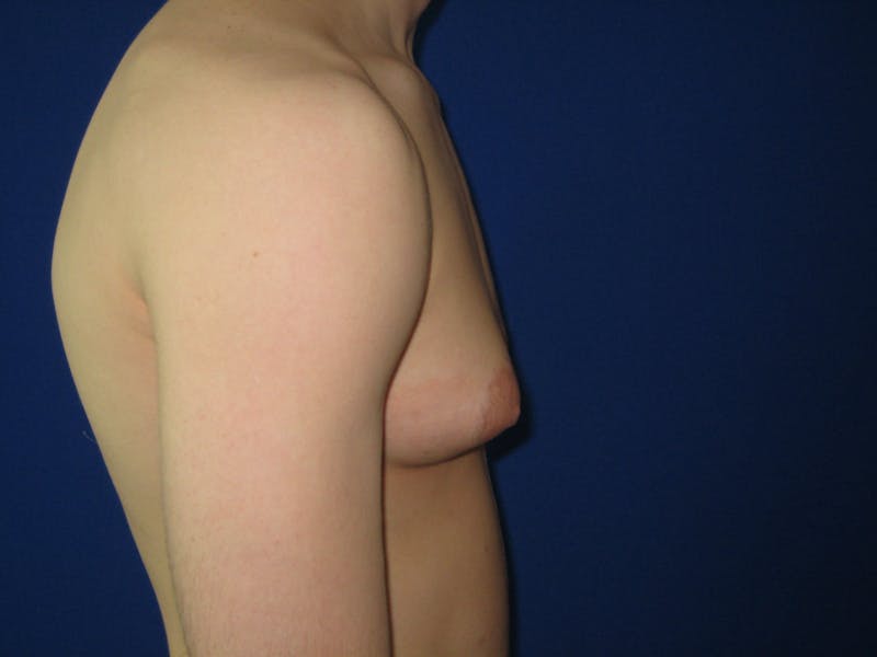 Gynecomastia Before & After Gallery - Patient 87551610 - Image 3