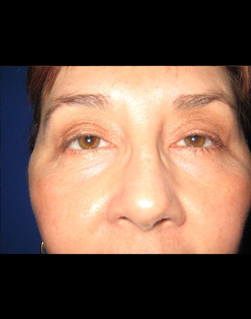 Necklift Before & After Gallery - Patient 87551617 - Image 4