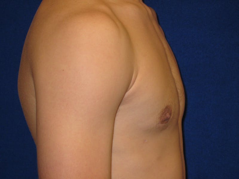 Gynecomastia Before & After Gallery - Patient 87551610 - Image 4