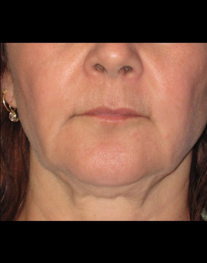 Necklift Before & After Gallery - Patient 87551617 - Image 5