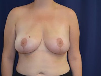 Breast Reduction Before & After Gallery - Patient 87551618 - Image 2