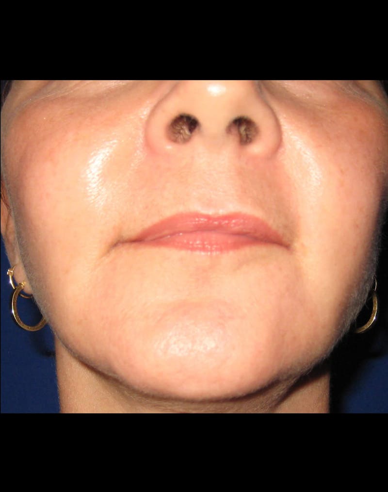 Necklift Before & After Gallery - Patient 87551617 - Image 6