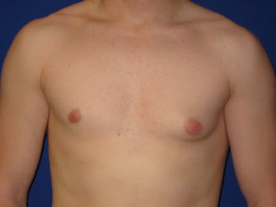 Gynecomastia Before & After Gallery - Patient 87551620 - Image 1