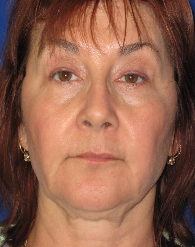 Necklift Before & After Gallery - Patient 87551617 - Image 7