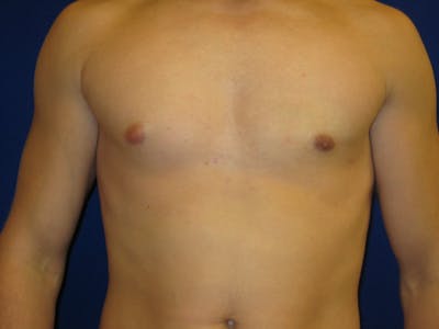 Gynecomastia Before & After Gallery - Patient 87551620 - Image 2