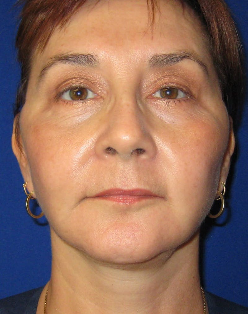 Necklift Before & After Gallery - Patient 87551617 - Image 8