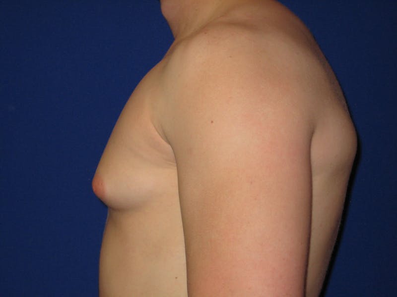Gynecomastia Before & After Gallery - Patient 87551620 - Image 3