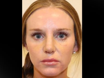 Rhinoplasty/Nose Reshaping Before & After Gallery - Patient 87551646 - Image 2