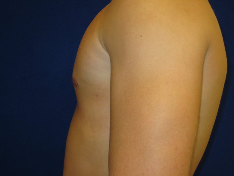 Gynecomastia Before & After Gallery - Patient 87551620 - Image 4