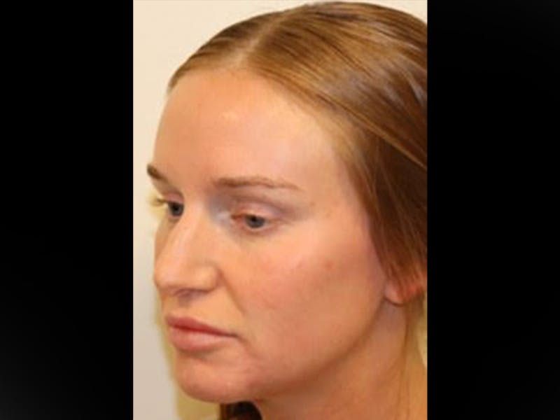 Rhinoplasty/Nose Reshaping Before & After Gallery - Patient 87551646 - Image 3