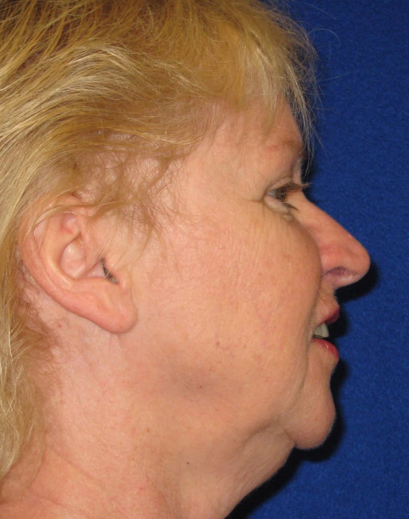 Necklift Before & After Gallery - Patient 87551629 - Image 3
