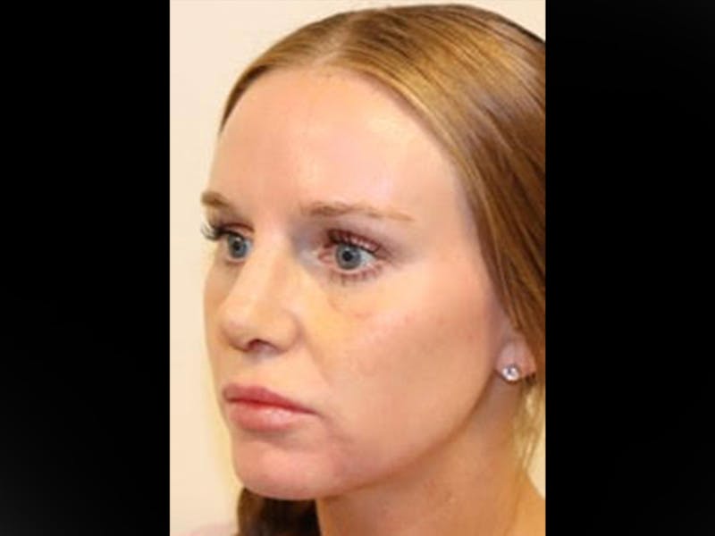 Rhinoplasty/Nose Reshaping Before & After Gallery - Patient 87551646 - Image 4