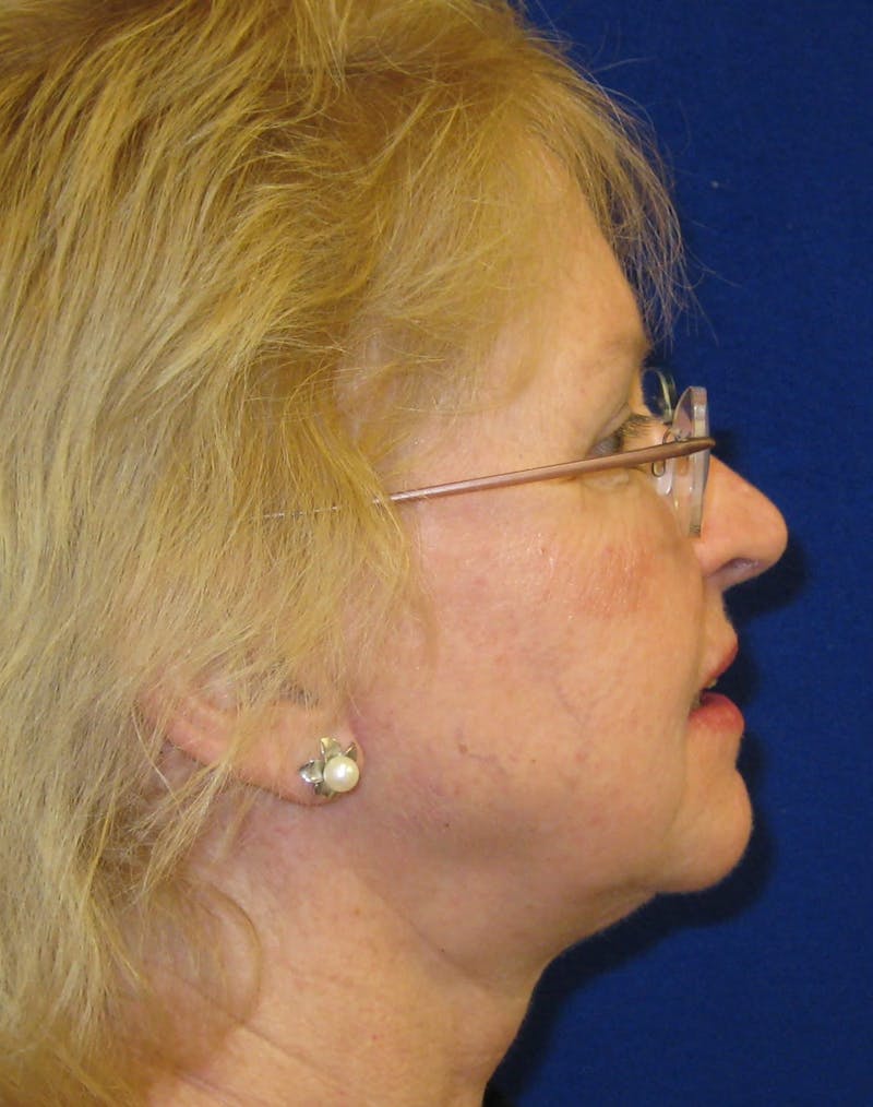 Necklift Before & After Gallery - Patient 87551629 - Image 4